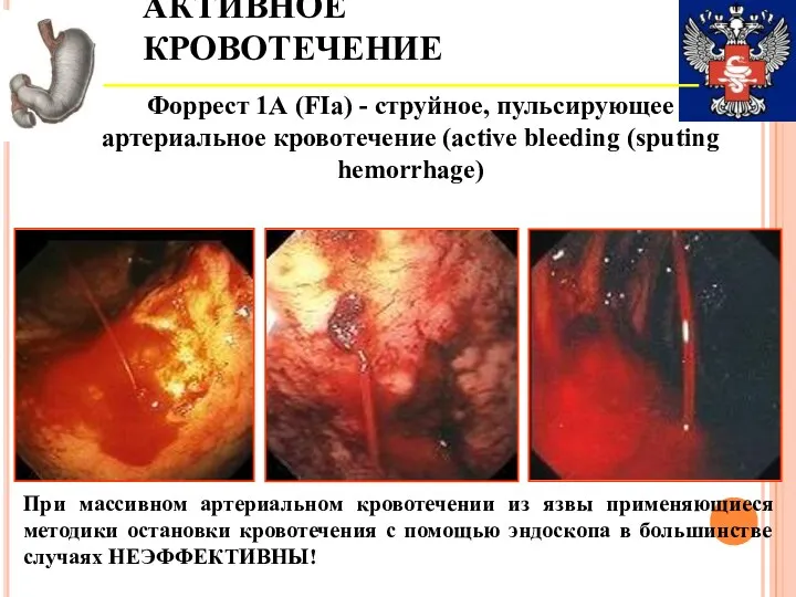 АКТИВНОЕ КРОВОТЕЧЕНИЕ Форрест 1А (FIa) - струйное, пульсирующее артериальное кровотечение