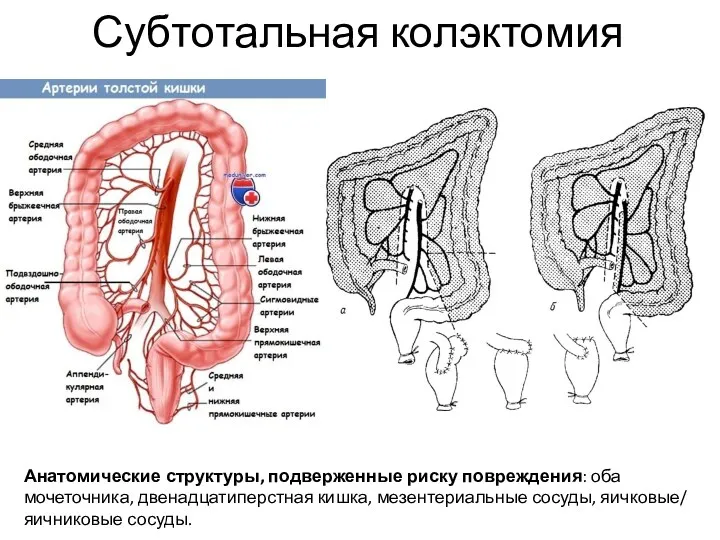 Субтотальная колэктомия Анатомические структуры, подверженные риску повреждения: оба мочеточника, двенадцатиперстная кишка, мезентериальные сосуды, яичковые/ яичниковые сосуды.