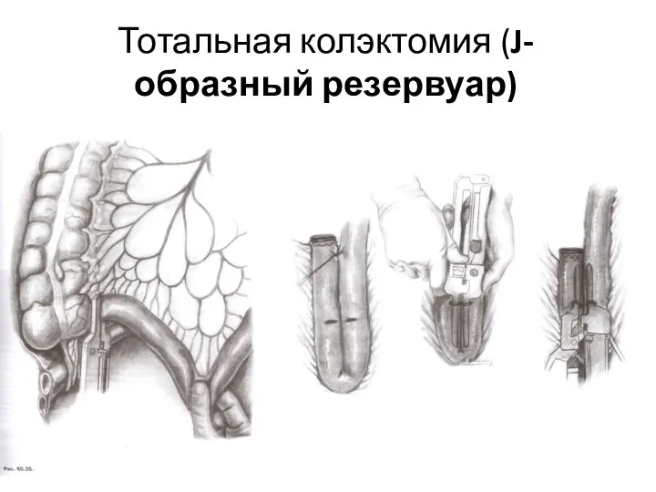 Тотальная колэктомия (J-образный резервуар)