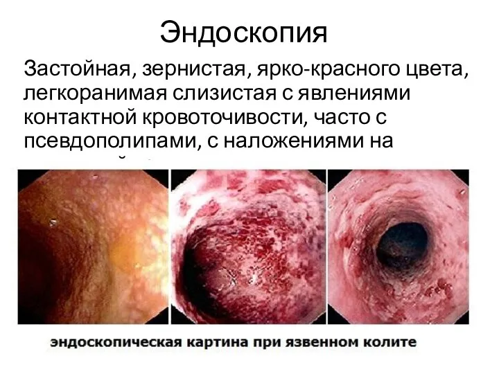 Эндоскопия Застойная, зернистая, ярко-красного цвета, легкоранимая слизистая с явлениями контактной