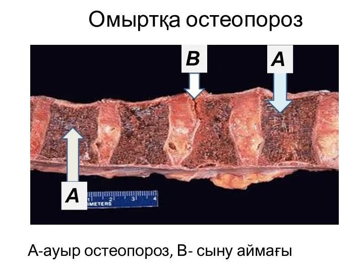 Омыртқа остеопороз А-ауыр остеопороз, В- сыну аймағы А А В