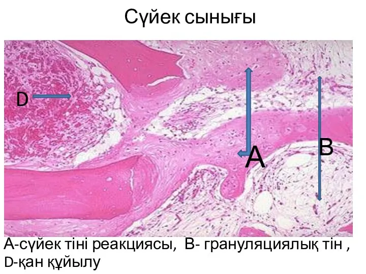 Сүйек сынығы А-сүйек тіні реакциясы, В- грануляциялық тін , D-қан құйылу А D В