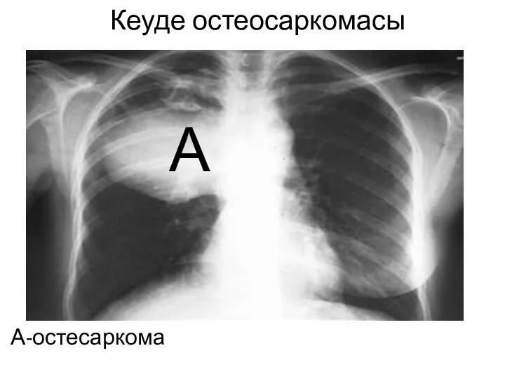 Кеуде остеосаркомасы А-остесаркома А