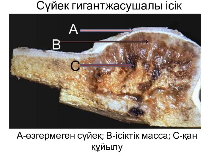 Сүйек гигантжасушалы ісік А-өзгермеген сүйек; В-ісіктік масса; С-қан құйылу А В С