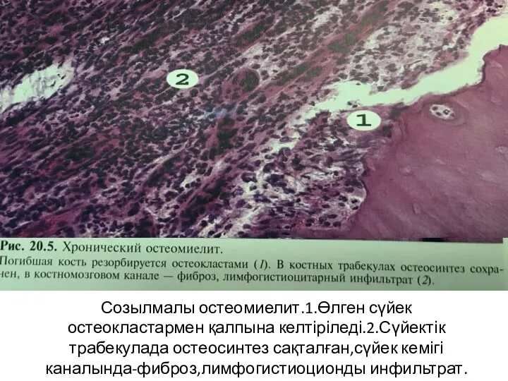 Созылмалы остеомиелит.1.Өлген сүйек остеокластармен қалпына келтіріледі.2.Сүйектік трабекулада остеосинтез сақталған,сүйек кемігі каналында-фиброз,лимфогистиоционды инфильтрат.