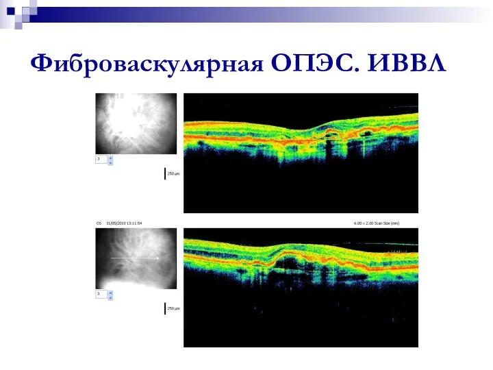 Фиброваскулярная ОПЭС. ИВВЛ