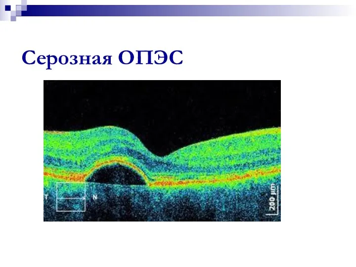 Серозная ОПЭС