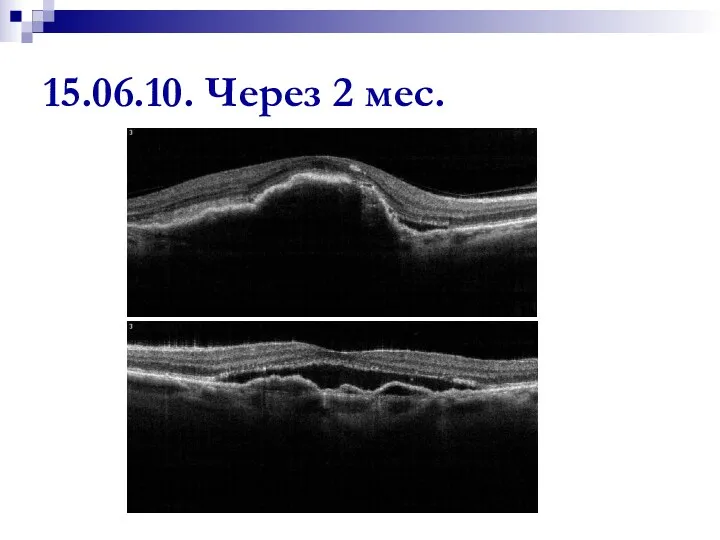 15.06.10. Через 2 мес.