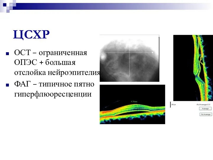 ЦСХР ОСТ – ограниченная ОПЭС + большая отслойка нейроэпителия ФАГ – типичное пятно гиперфлюоресценции