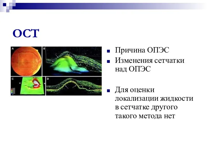 ОСТ Причина ОПЭС Изменения сетчатки над ОПЭС Для оценки локализации жидкости в сетчатке