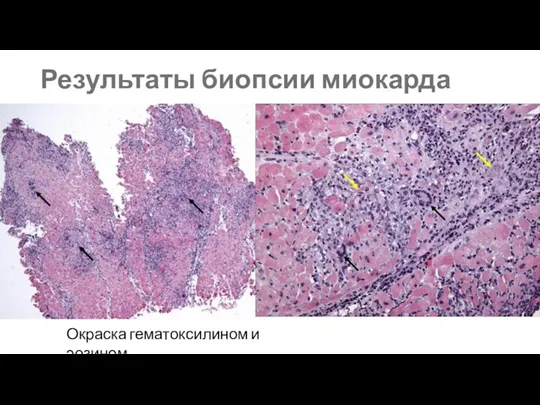 Результаты биопсии миокарда Окраска гематоксилином и эозином