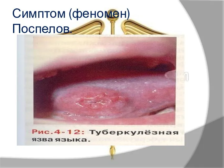 Симптом (феномен) Поспелов.