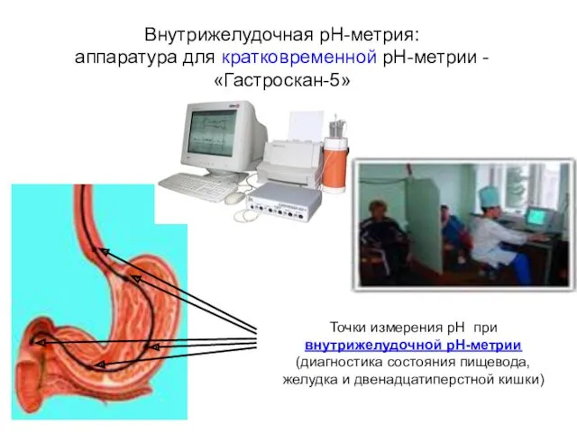 Точки измерения рН при внутрижелудочной pH-метрии (диагностика состояния пищевода, желудка