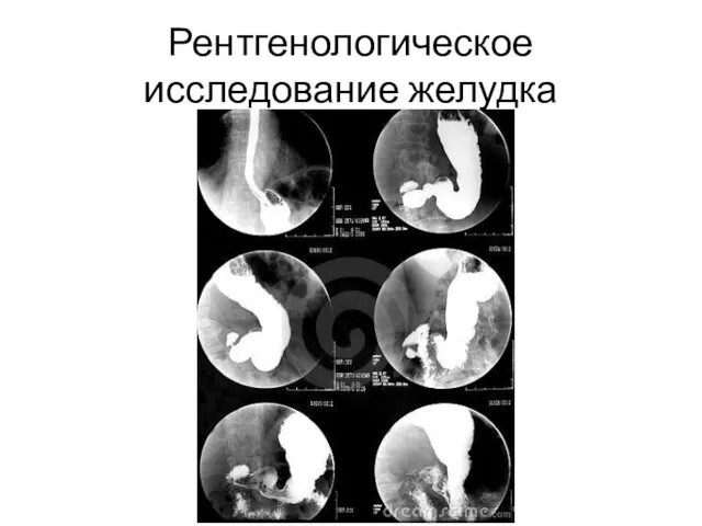 Рентгенологическое исследование желудка