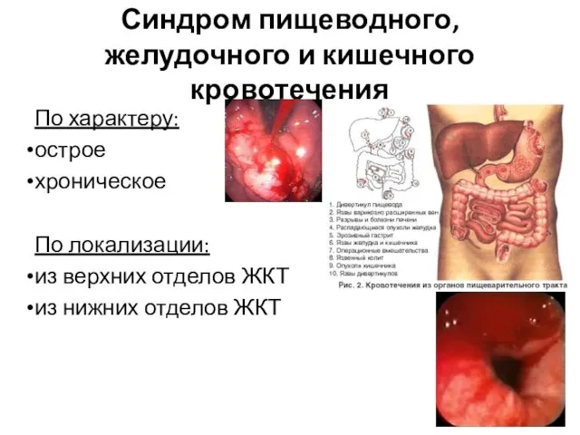 Синдром пищеводного, желудочного и кишечного кровотечения По характеру: острое хроническое