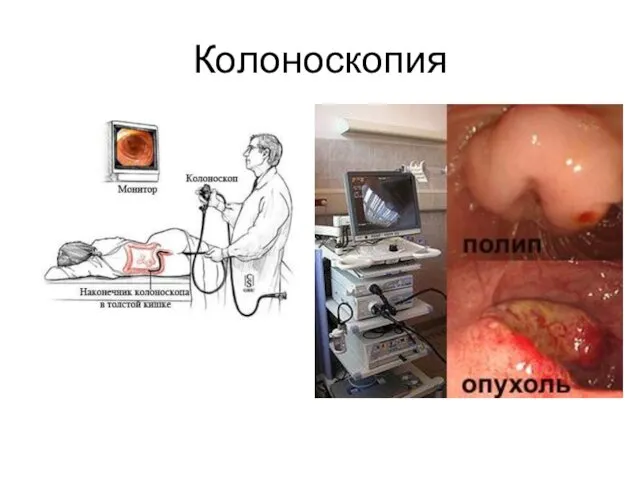 Колоноскопия