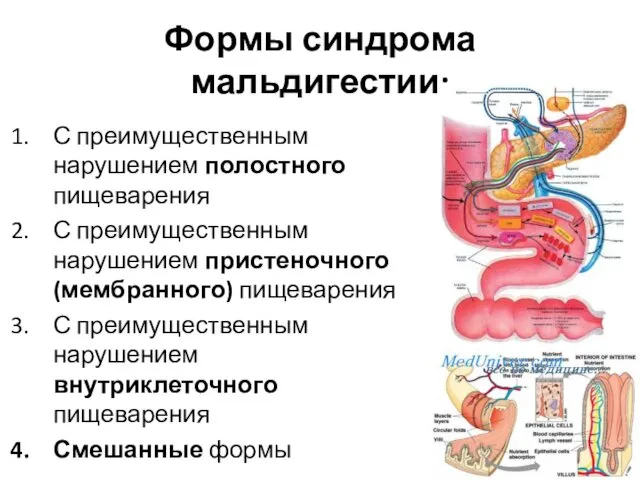 Формы синдрома мальдигестии: С преимущественным нарушением полостного пищеварения С преимущественным