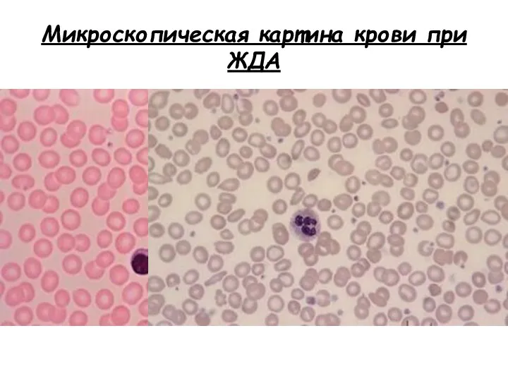 Микроскопическая картина крови при ЖДА