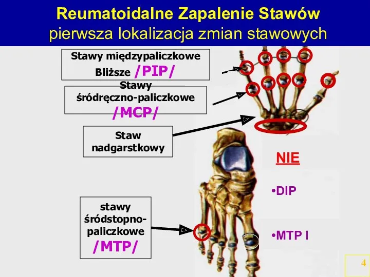 stawy śródstopno- paliczkowe /MTP/ Staw nadgarstkowy Stawy śródręczno-paliczkowe /MCP/ Stawy