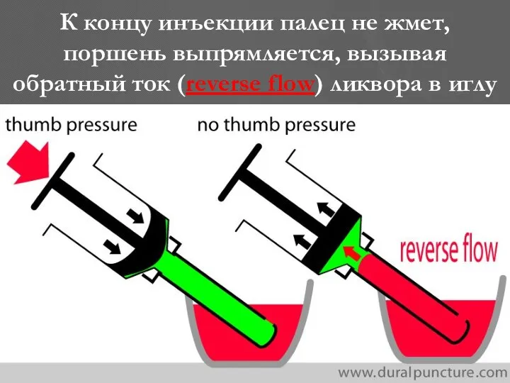 К концу инъекции палец не жмет, поршень выпрямляется, вызывая обратный