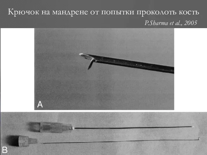 Крючок на мандрене от попытки проколоть кость P.Sharma et al., 2005