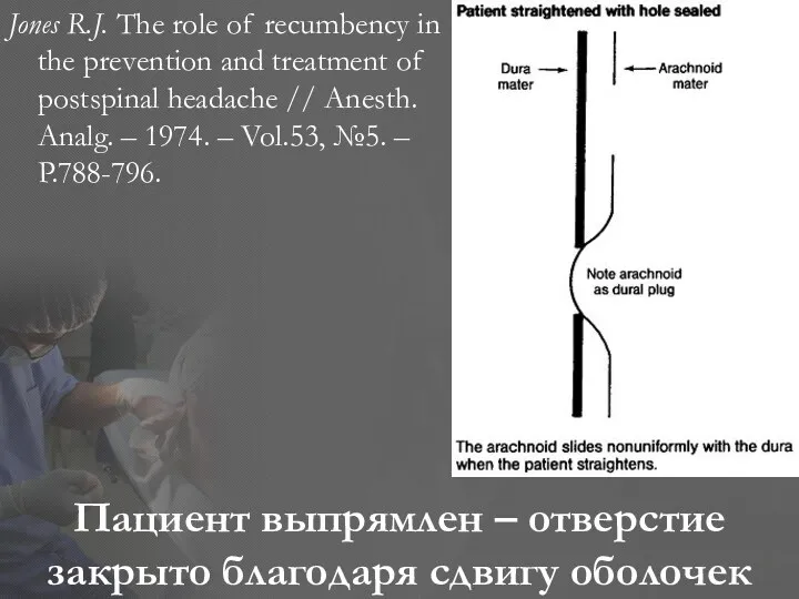 Пациент выпрямлен – отверстие закрыто благодаря сдвигу оболочек Jones R.J.