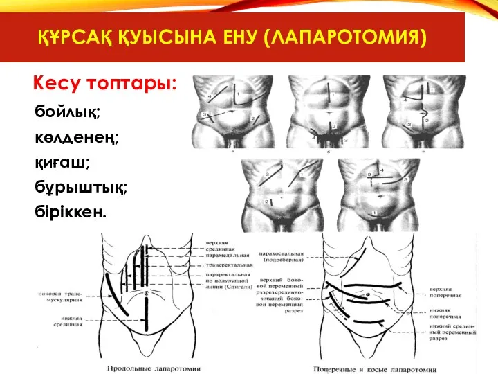 ҚҰРСАҚ ҚУЫСЫНА ЕНУ (ЛАПАРОТОМИЯ) Кесу топтары: бойлық; көлденең; қиғаш; бұрыштық; біріккен.