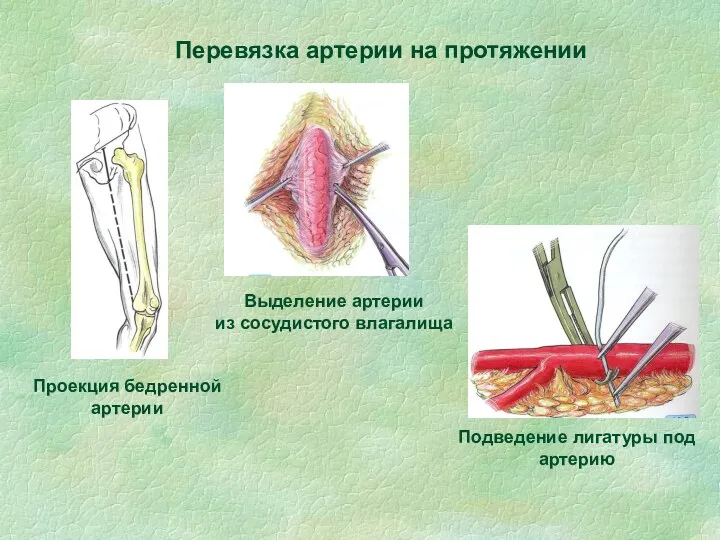 Перевязка артерии на протяжении Проекция бедренной артерии Выделение артерии из сосудистого влагалища Подведение лигатуры под артерию