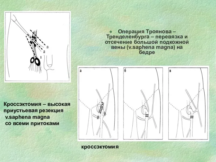 Операция Троянова –Тренделенбурга – перевязка и отсечение большой подкожной вены