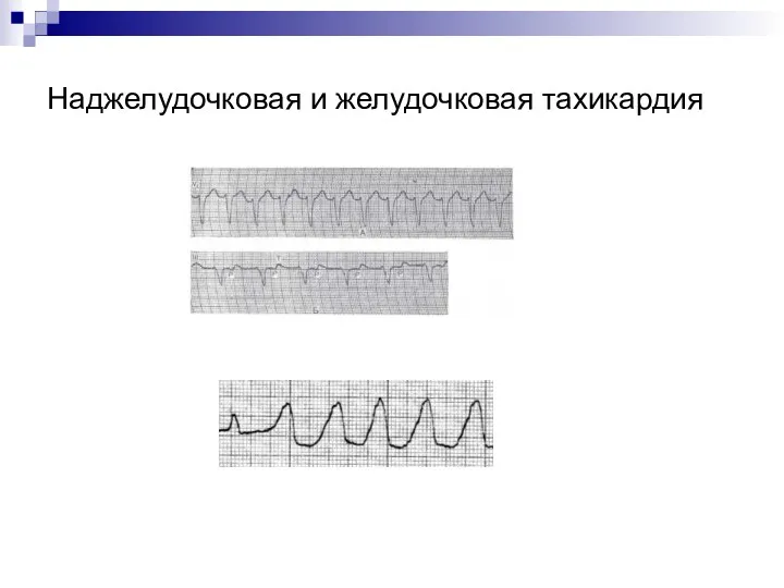 Наджелудочковая и желудочковая тахикардия