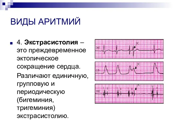 ВИДЫ АРИТМИЙ 4. Экстрасистолия – это преждевременное эктопическое сокращение сердца.