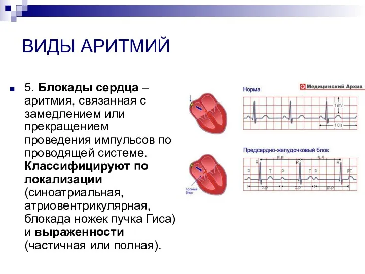 ВИДЫ АРИТМИЙ 5. Блокады сердца – аритмия, связанная с замедлением