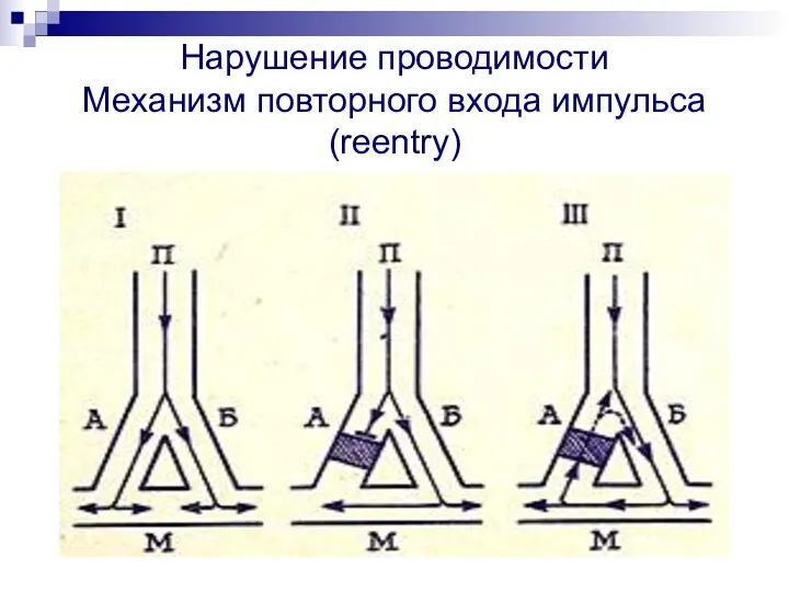 Нарушение проводимости Механизм повторного входа импульса (reentry)