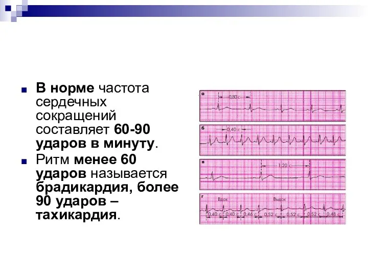 В норме частота сердечных сокращений составляет 60-90 ударов в минуту.