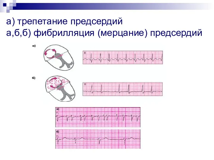 а) трепетание предсердий а,б,б) фибрилляция (мерцание) предсердий