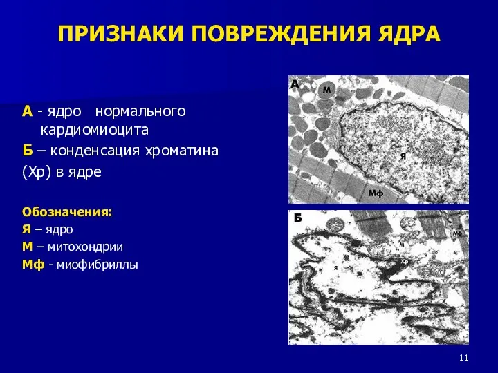 А - ядро нормального кардиомиоцита Б – конденсация хроматина (Хр)