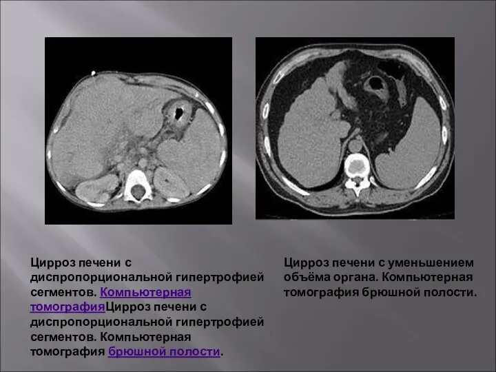 Цирроз печени с диспропорциональной гипертрофией сегментов. Компьютерная томографияЦирроз печени с