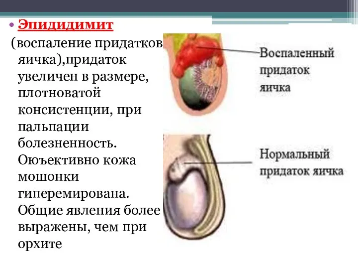 Эпидидимит (воспаление придатков яичка),придаток увеличен в размере, плотноватой консистенции, при