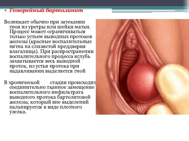 Гонорейный бартолинит Возникает обычно при затекании гноя из уретры или
