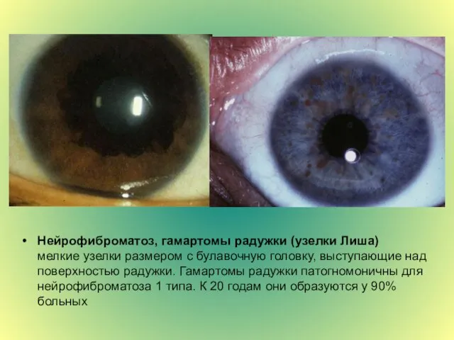 Нейрофиброматоз, гамартомы радужки (узелки Лиша) мелкие узелки размером с булавочную