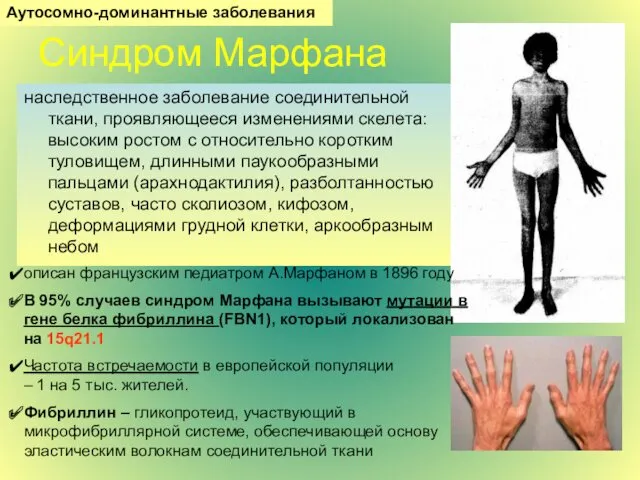 Синдром Марфана наследственное заболевание соединительной ткани, проявляющееся изменениями скелета: высоким