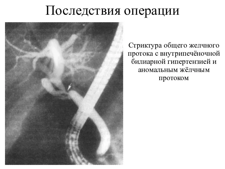 Последствия операции Стриктура общего желчного протока с внутрипечёночной билиарной гипертензией и аномальным жёлчным протоком