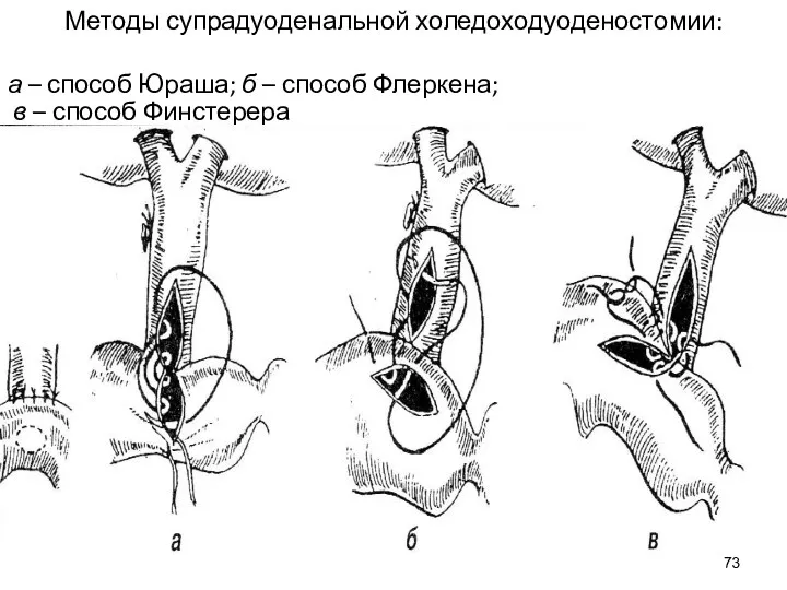 Методы супрадуоденальной холедоходуоденостомии: а – способ Юраша; б – способ Флеркена; в – способ Финстерера