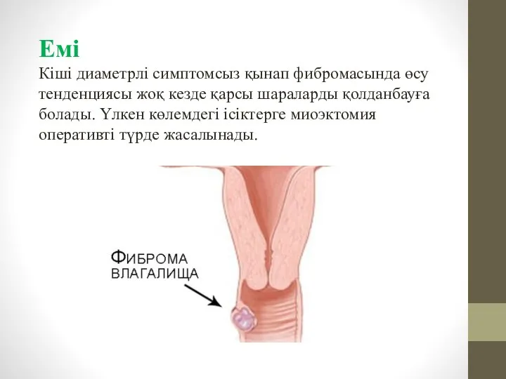 Емі Кіші диаметрлі симптомсыз қынап фибромасында өсу тенденциясы жоқ кезде