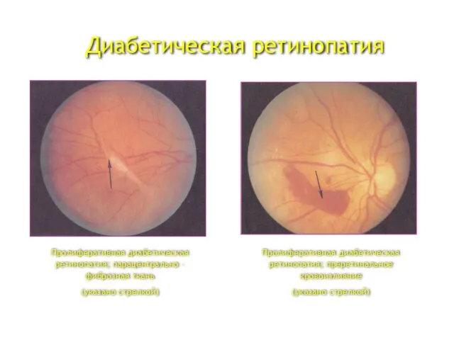 Диабетическая ретинопатия Пролиферативная диабетическая ретинопатия; парацентрально – фиброзная ткань (указано