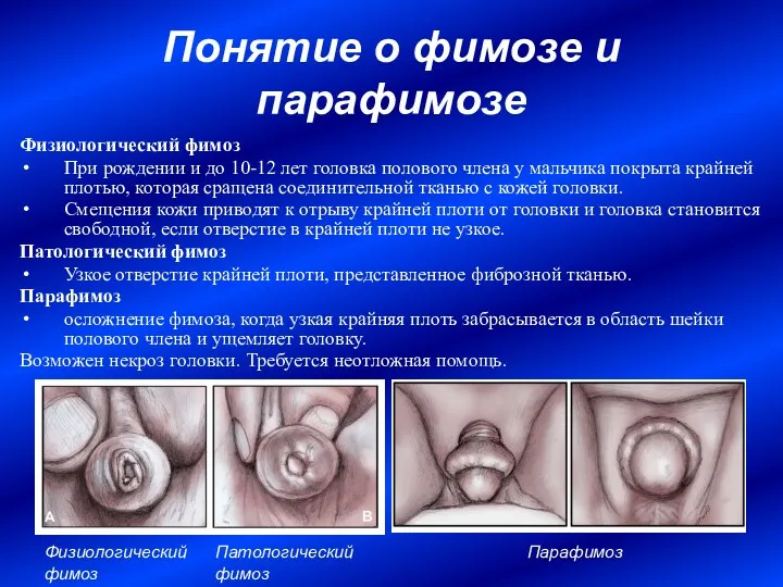 Понятие о фимозе и парафимозе Физиологический фимоз При рождении и