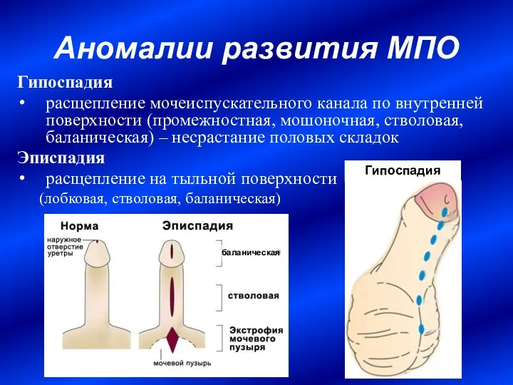 Аномалии развития МПО Гипоспадия расщепление мочеиспускательного канала по внутренней поверхности