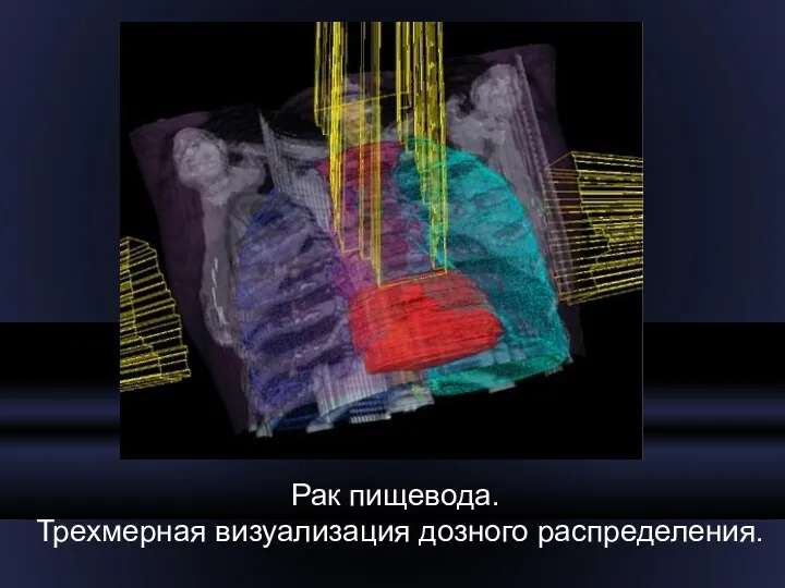 Рак пищевода. Трехмерная визуализация дозного распределения.