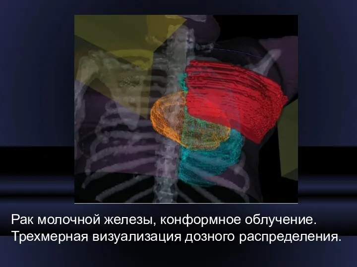 Рак молочной железы, конформное облучение. Трехмерная визуализация дозного распределения.