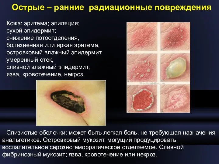 Острые – ранние радиационные повреждения Кожа: эритема; эпиляция; сухой эпидермит;